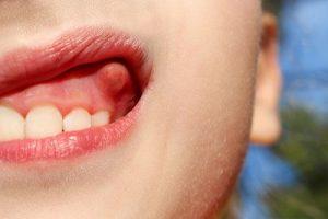 10 Ways to Get Rid of a Tooth Abscess Without Going to the Dentist
