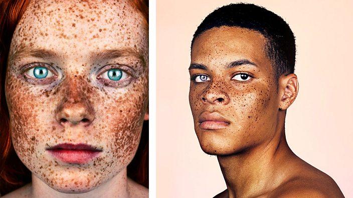 How to get freckles