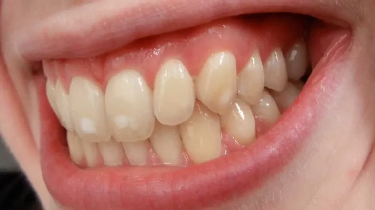 10 Ways to get rid of white spots on teeth easily