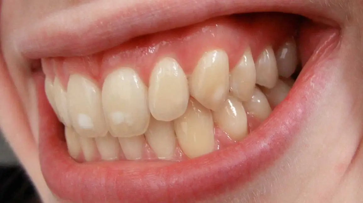 How to get rid of white spots on teeth